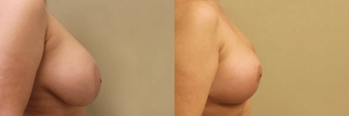 50 year old female before and after 225cc breast implant removal with breast reduction and lift side view