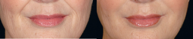 Restylane Before and After treatment for Smile Lines.png