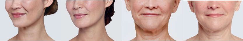 Restylane Lyft to Cheeks and Nasolabial Folds