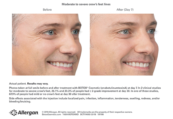 Botox Results for Crows Feet in Men