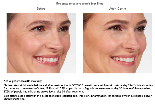 Botox Results for Crows Feet in Women