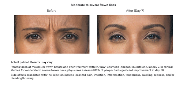 Botox Results for Moderate or Severe Frown Lines