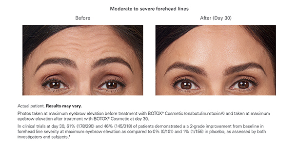Botox Results for Moderate or Severe Forehead Lines
