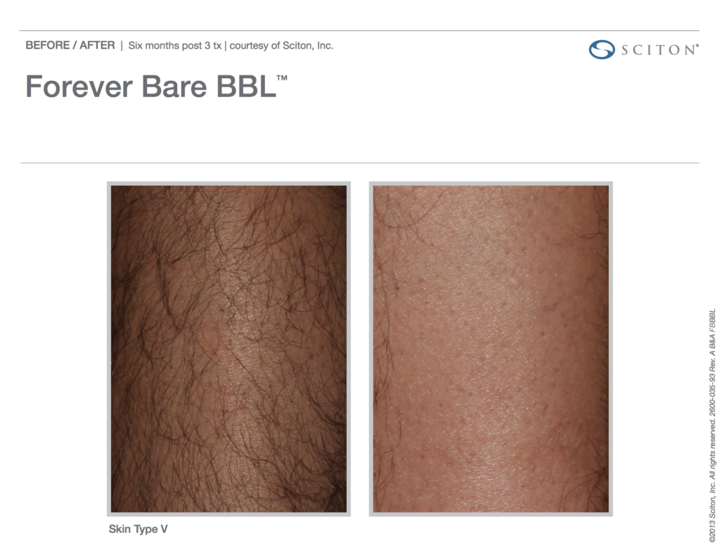 BBL Forever Bare Before and After Photo 1