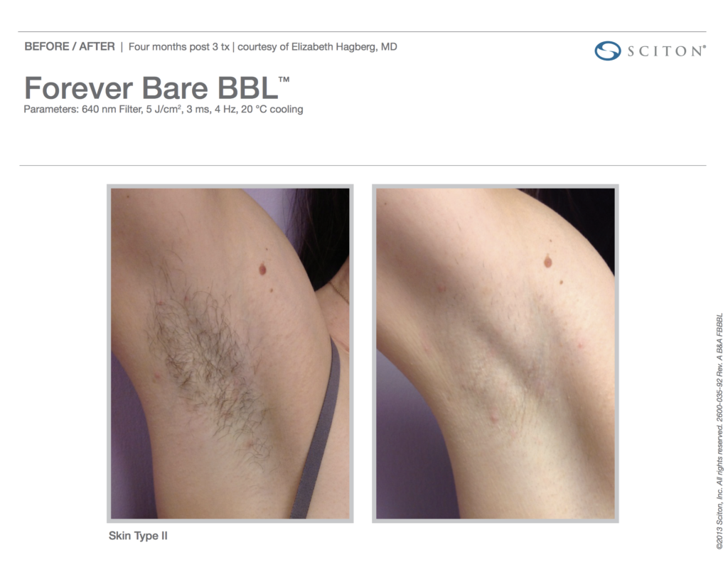 BBL Forever Bare Before and After Photo 2