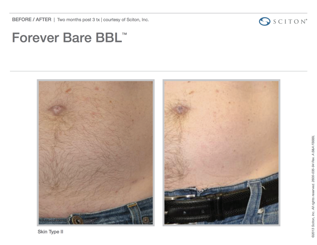 BBL Forever Bare Before and After Photo 3