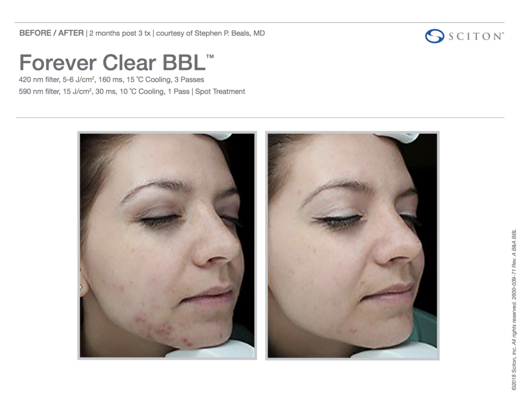 BBL Forever Clear Before and After Acne 1