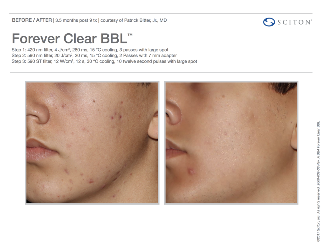 BBL Forever Clear Before and After Acne 3