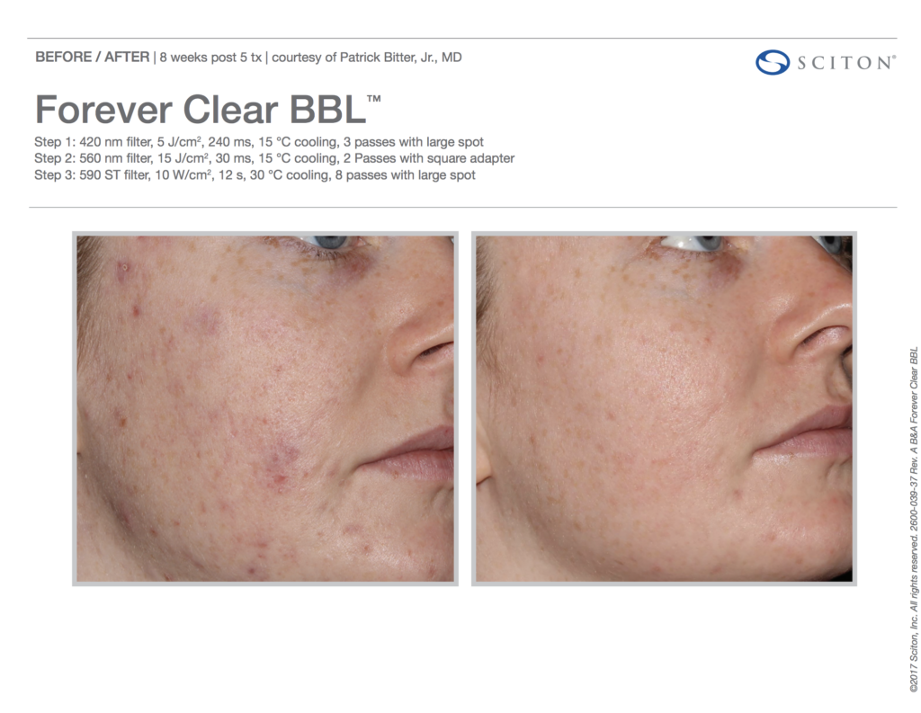 BBL Forever Clear Before and After Acne 4