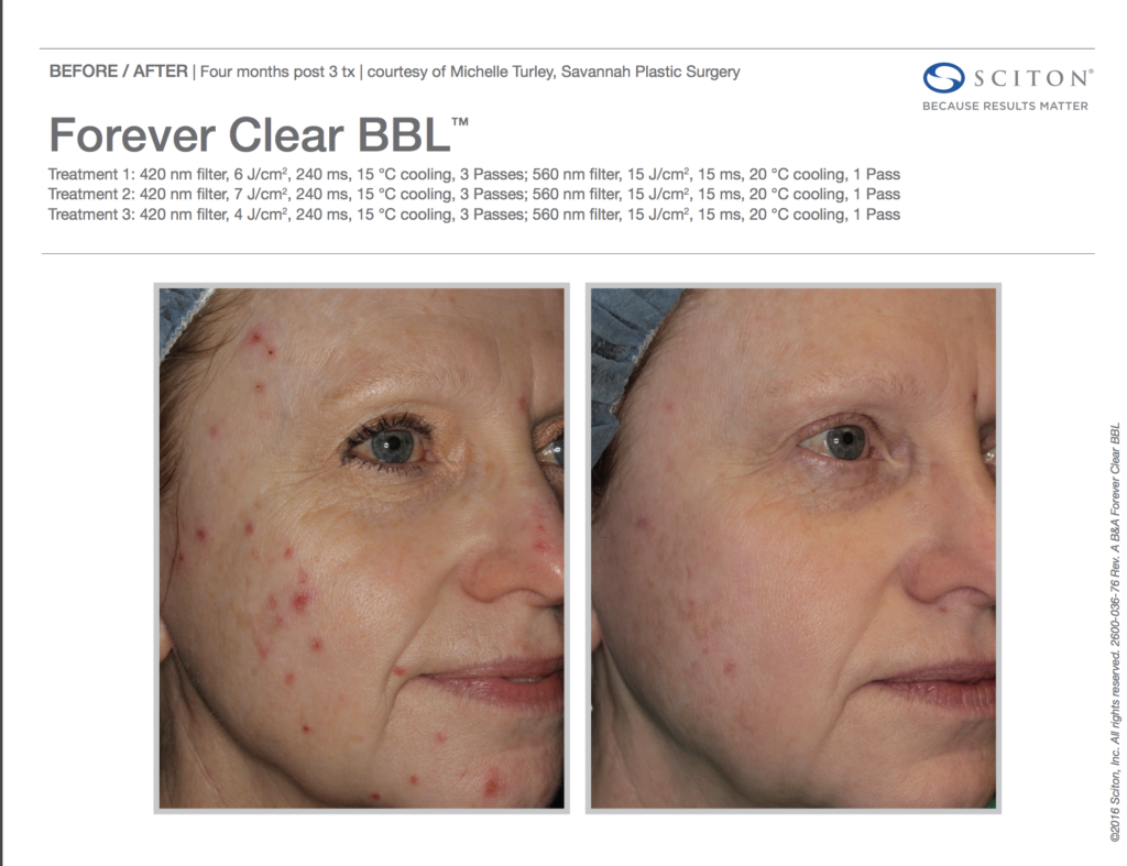 BBL Forever Clear Before and After Acne 5