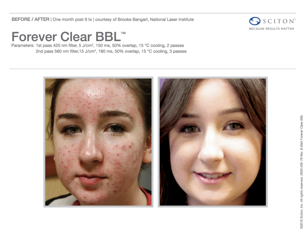 BBL Forever Clear Before and After Acne 6