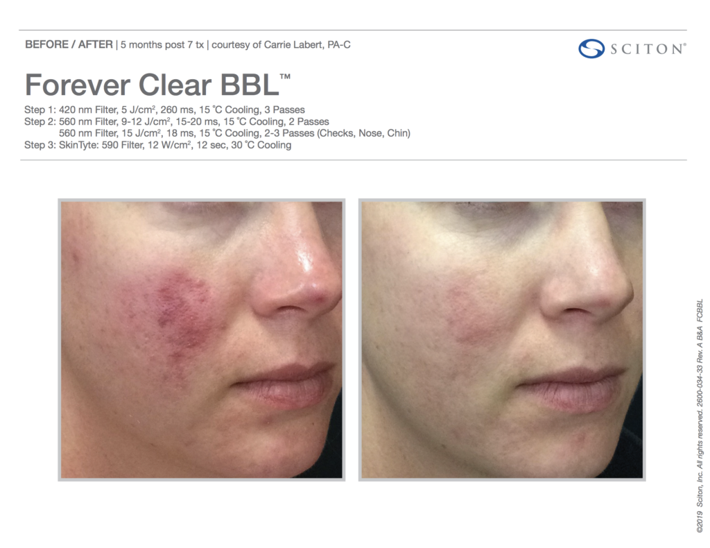 BBL Forever Clear Before and After Acne 6