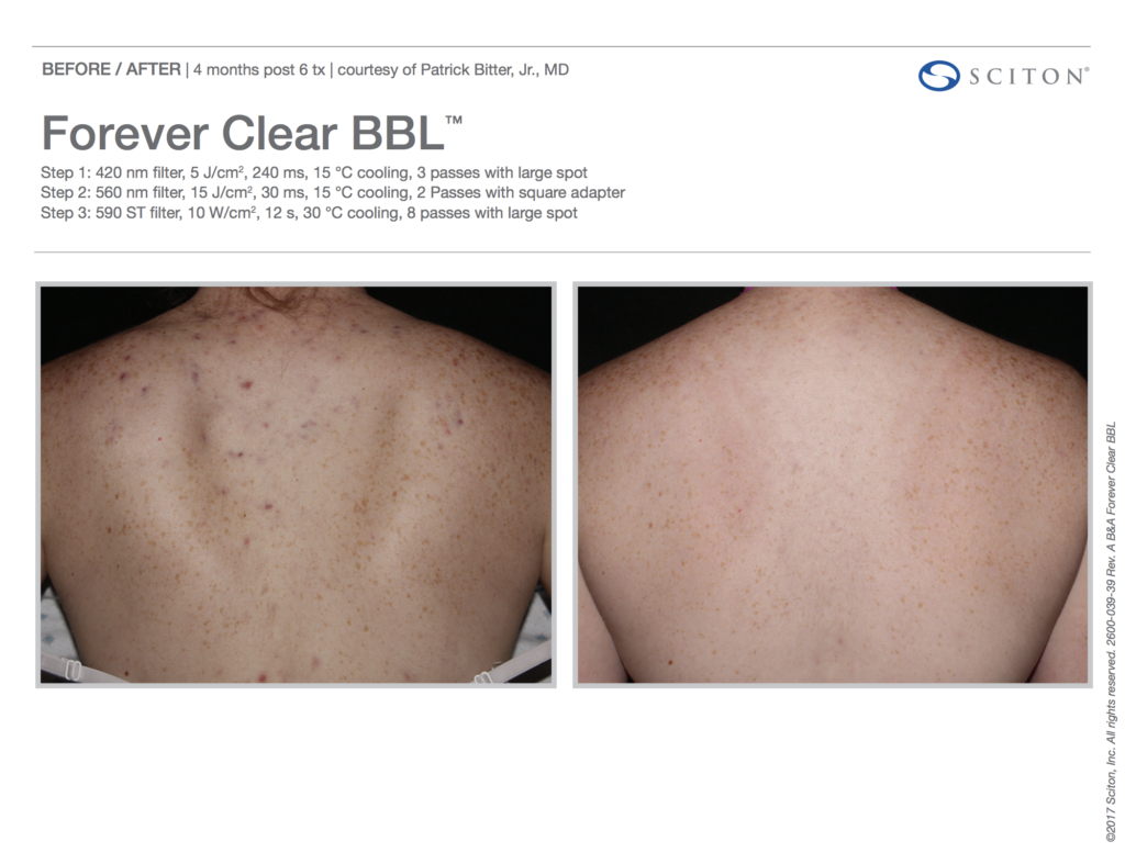 BBL Forever Clear Before and After Acne on Back