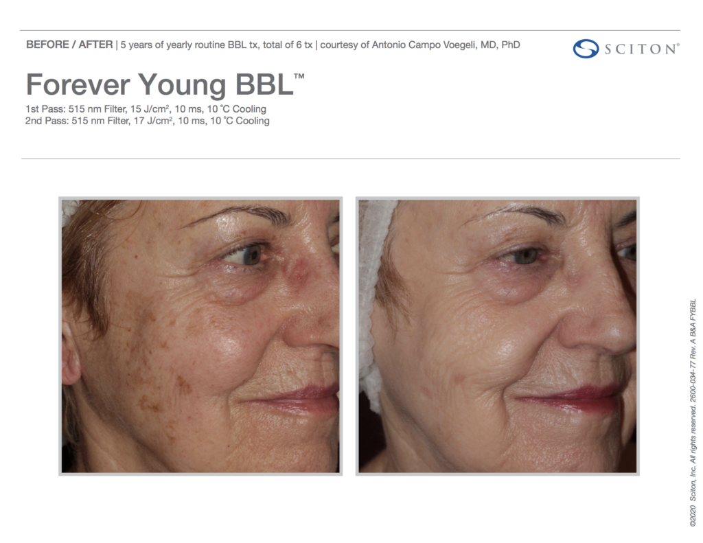 Forever Young BBL Before and After Photos 2