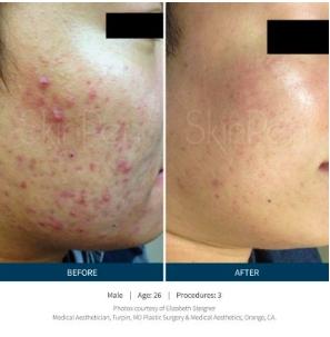 Microneedling Before and After - Cheeks