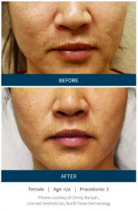 Microneedling Before and After - Chin and Jawline