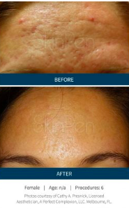 Microneedling Before and After - Forehead