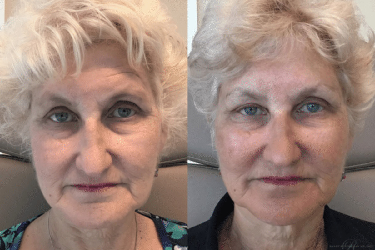 Female before and after Full Facial Correction With Injectables and Fillers