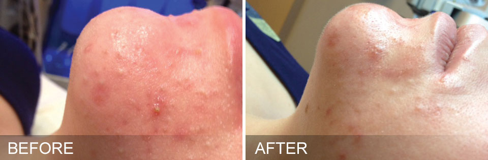 Hydrafacial Before and After Photo of Oily Congested Skin