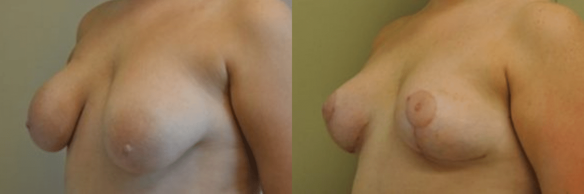 24 year old tubular breast correction and congenital asymmetry before and after side view