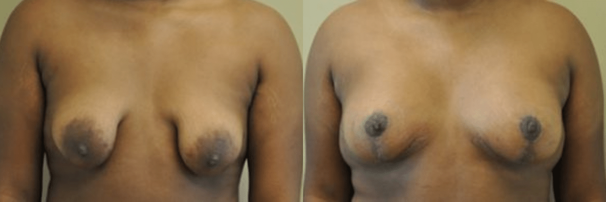 18 year old tubular breast correction and congenital asymmetry before and after front view
