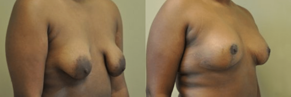 18 year old tubular breast correction and congenital asymmetry before and after side view