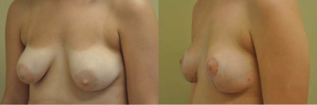24 year old tubular breast correction and severe asymmetry before and after side view