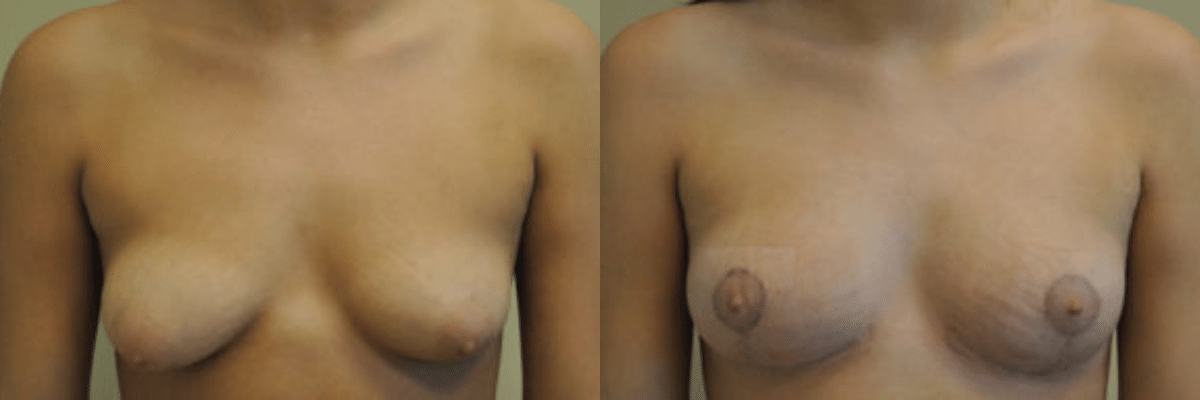 18 year old before and after tubular breast and asymmetry correction surgery front view