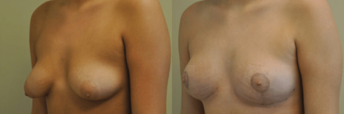 18 year old before and after tubular breast and asymmetry correction surgery side view