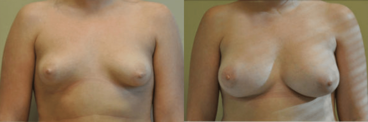 24 year old female before and after 375cc implant breast augmentation to correct tubular breasts front view