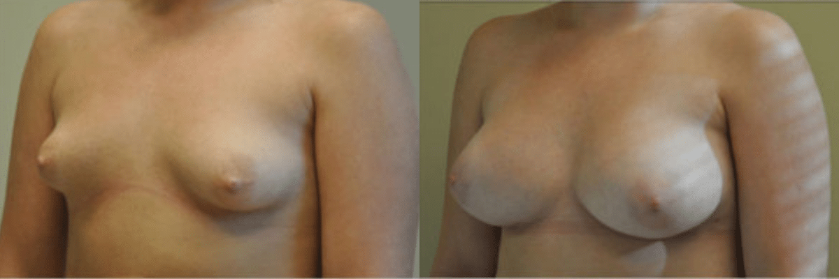 24 year old female before and after 375cc implant breast augmentation to correct tubular breasts side view