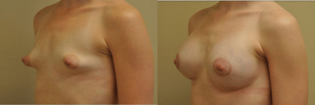 28 year old tubular breast correction before and after side view