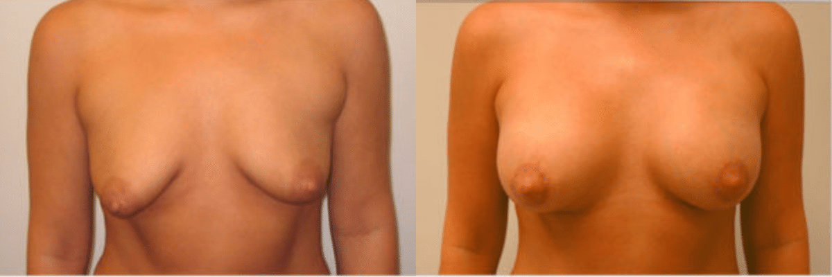 24 year old tubular breast correction before and after front view