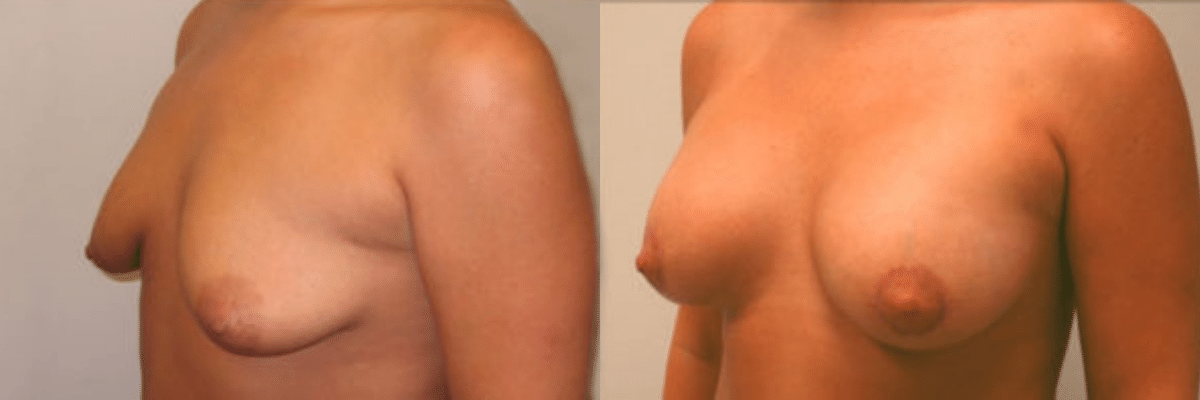 24 year old tubular breast correction before and after side view
