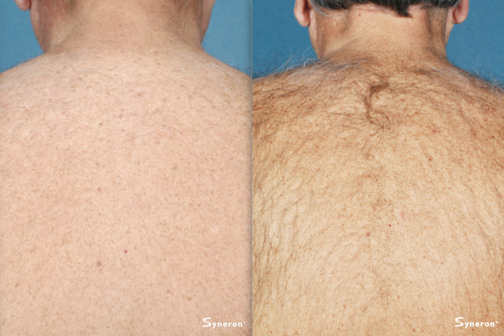 elos laser hair removal before and after of back