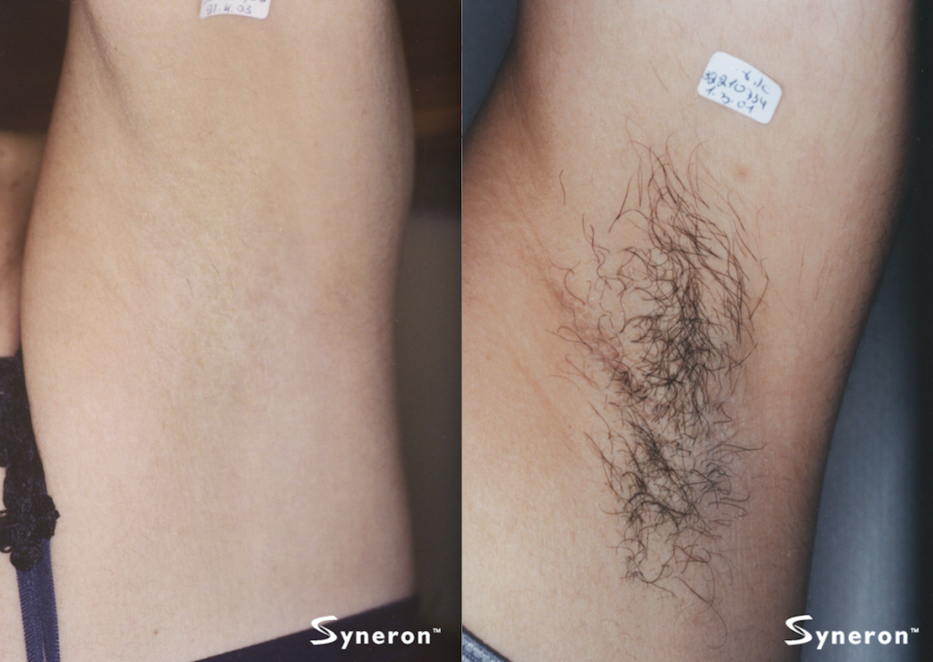elos laser hair removal before and after of under arms