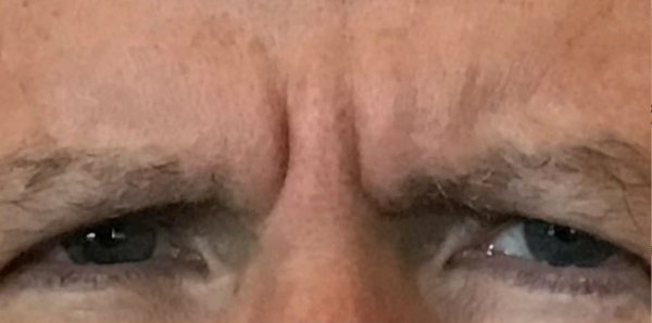 Male Forehead Botox Before
