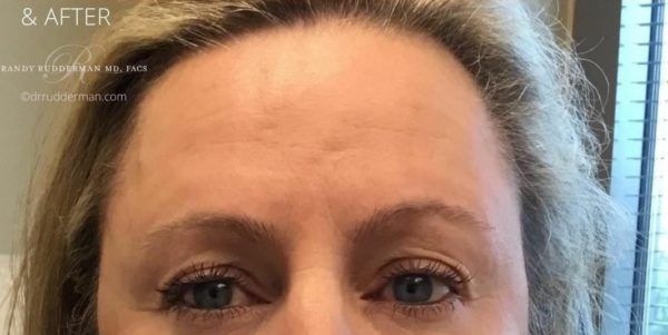 Botox After Photo for Forehead Lines