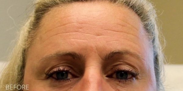 Botox Before Photo for Forehead Lines