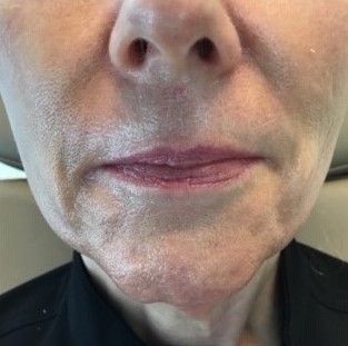 Dermal Filler Before Photo - Jawline, Chin, and Marionette Lines