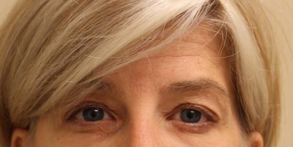Forehead and Temples - Botox After
