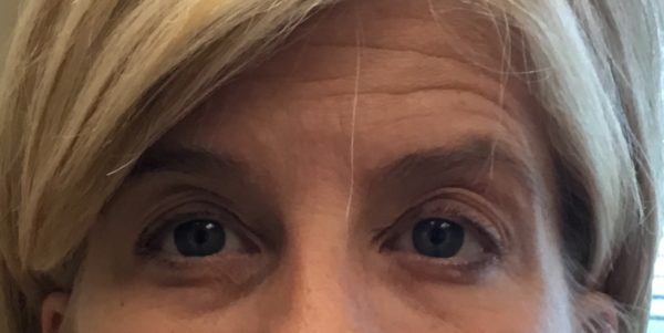Forehead and Temples - Botox Before