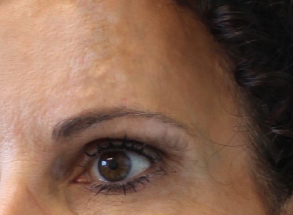 Injectable Correction for Temples - After