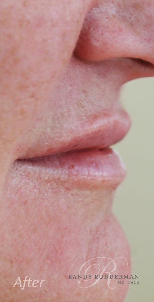 Juvederm Lip Augmentation After