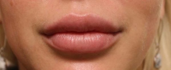 Juvederm Volbella Lip Enhancement - After