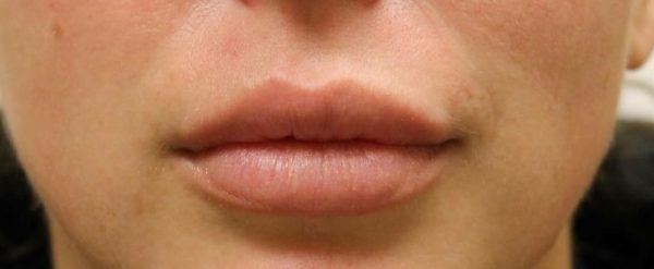 Juvederm Volbella Lip Enhancement - Before