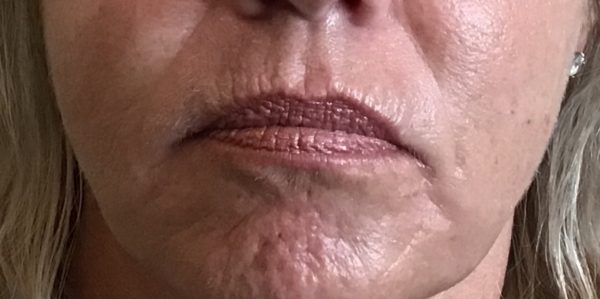Juvederm Vollure Lip Augmentation - Before