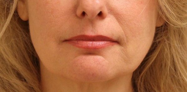 Marionette Line Correction With Juvederm Vollure - After