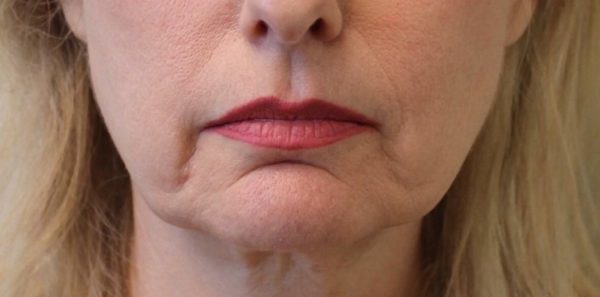 Marionette Line Correction With Juvederm Vollure - Before