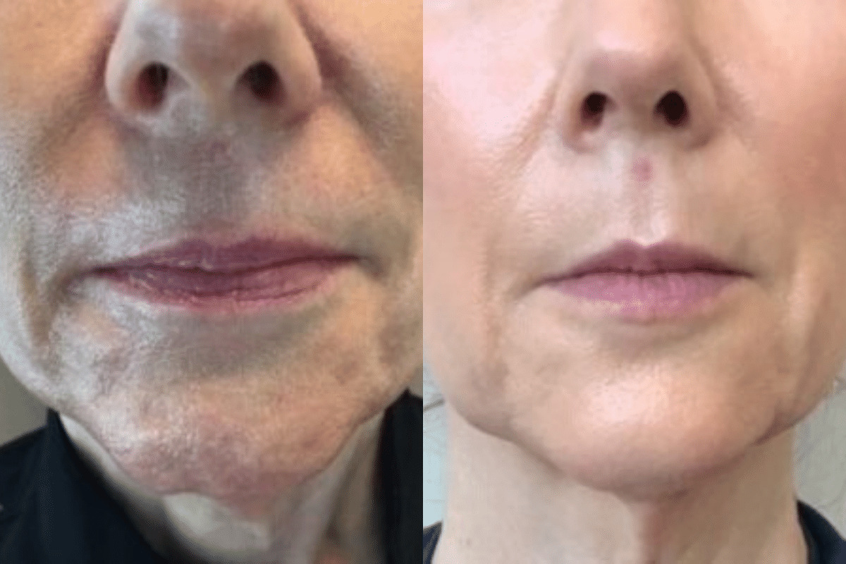 Patient 33578 Dermal Filler Before and After Jawline Chi Marionette Lines